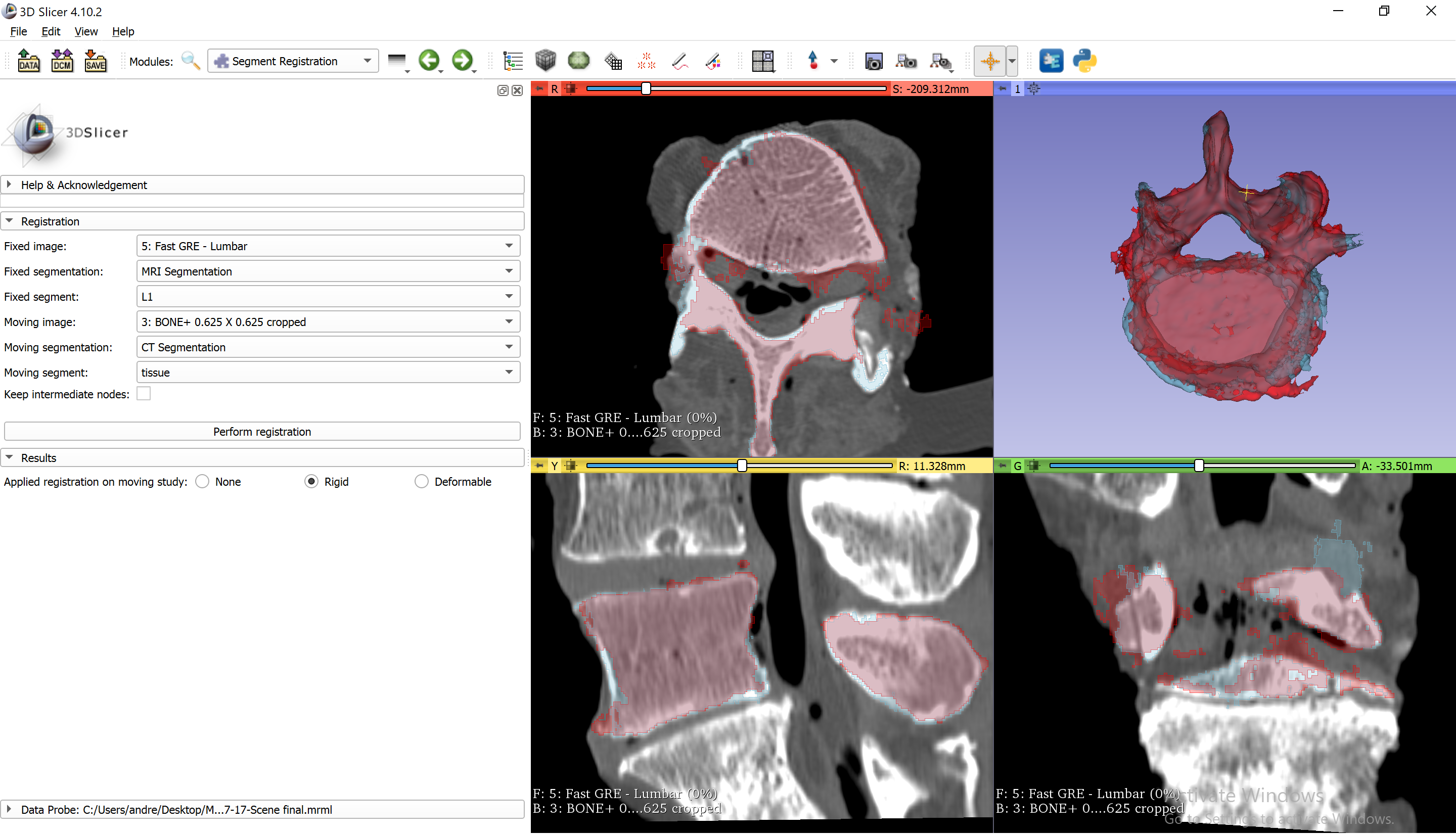 Segmentation on CT and MRI - after registration